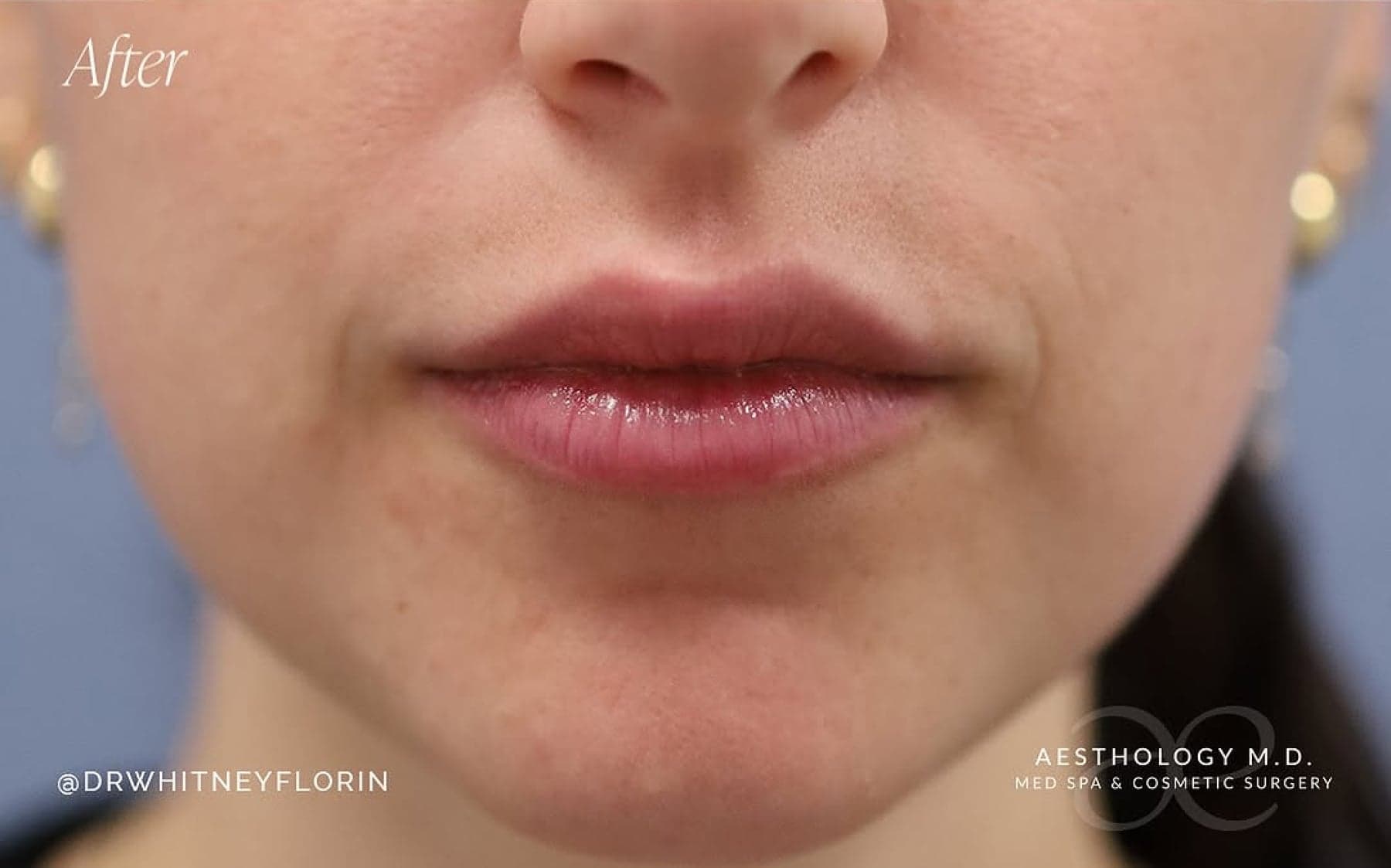 After treatment result