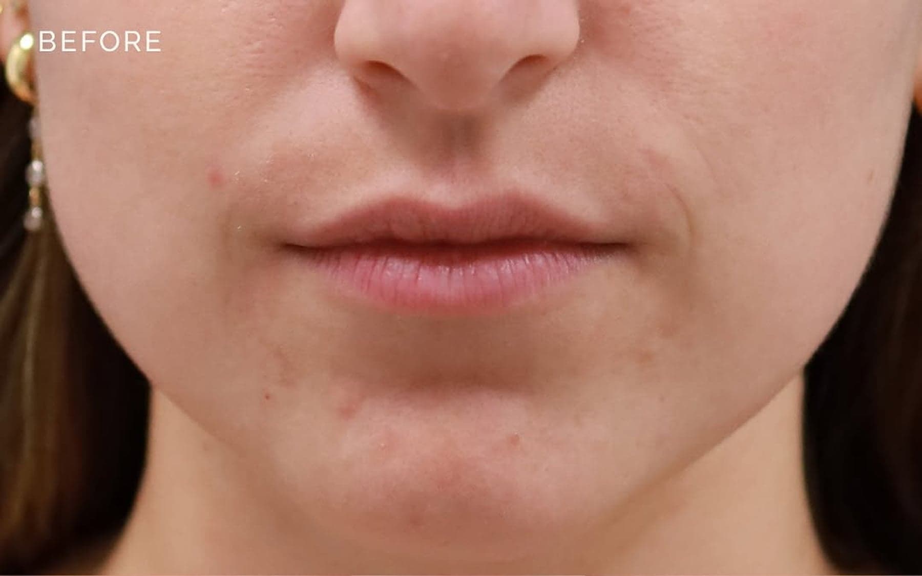 Before treatment