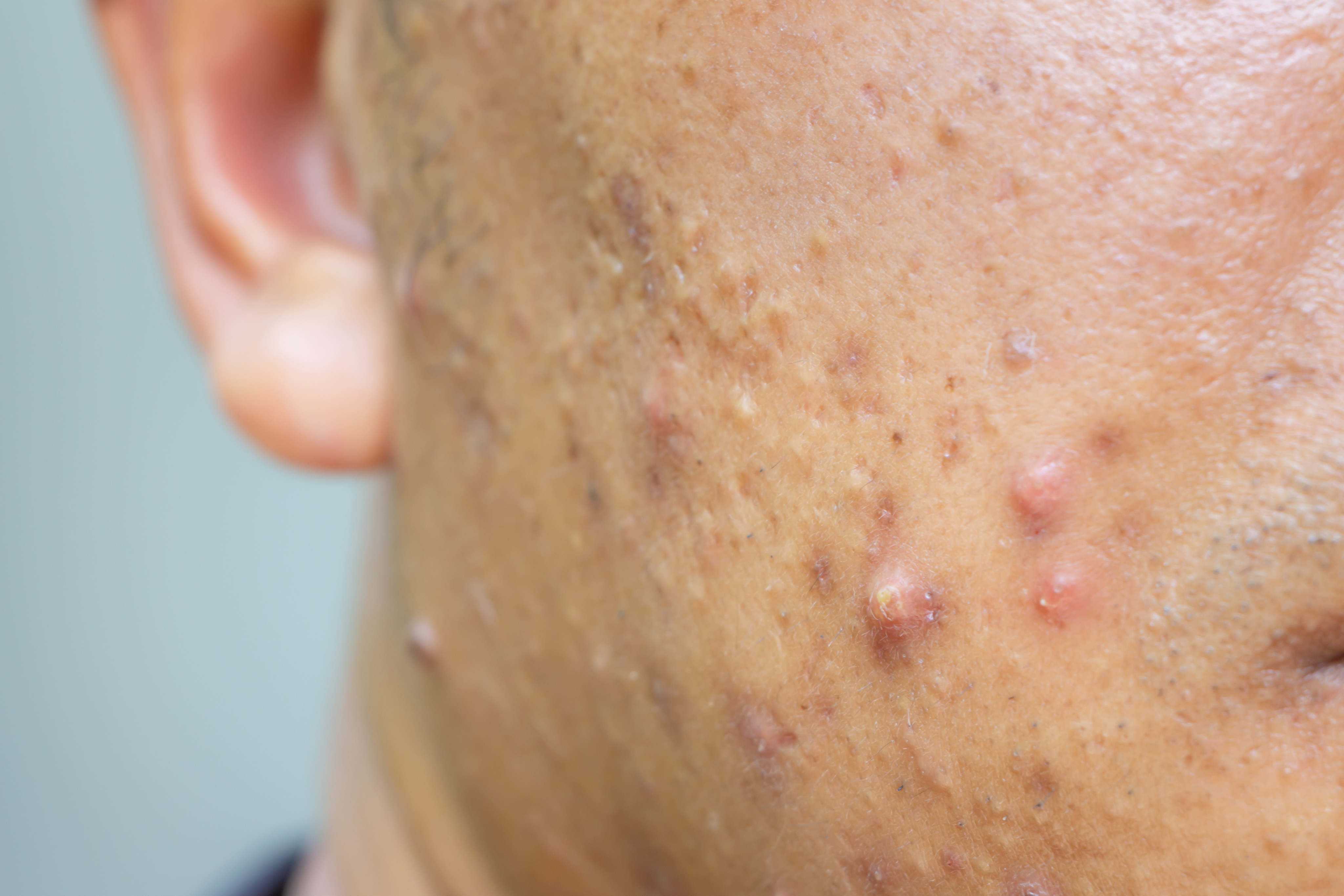 Acne Scars