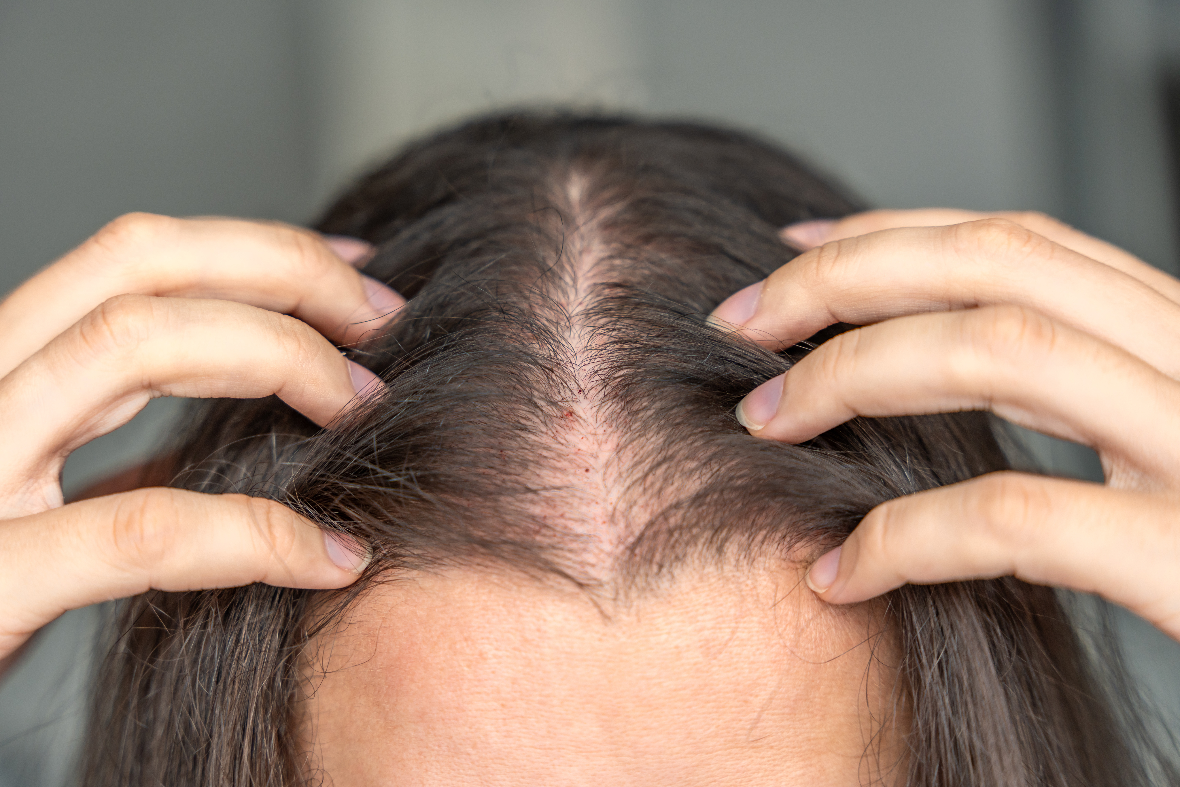 Hair Loss